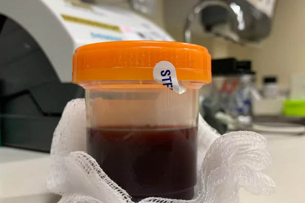 Blood in Urine<br />
